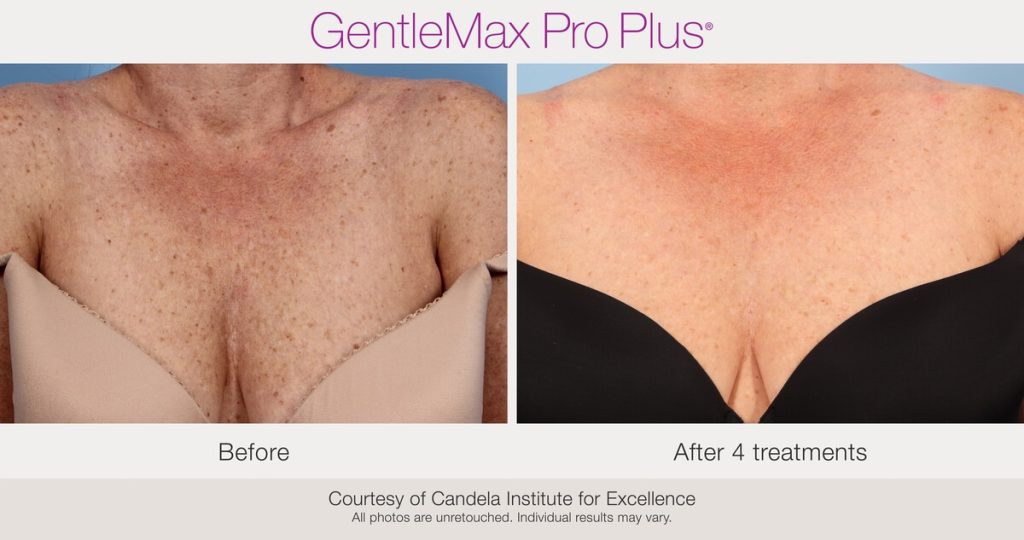 GentleMax Pro Plus before and after
